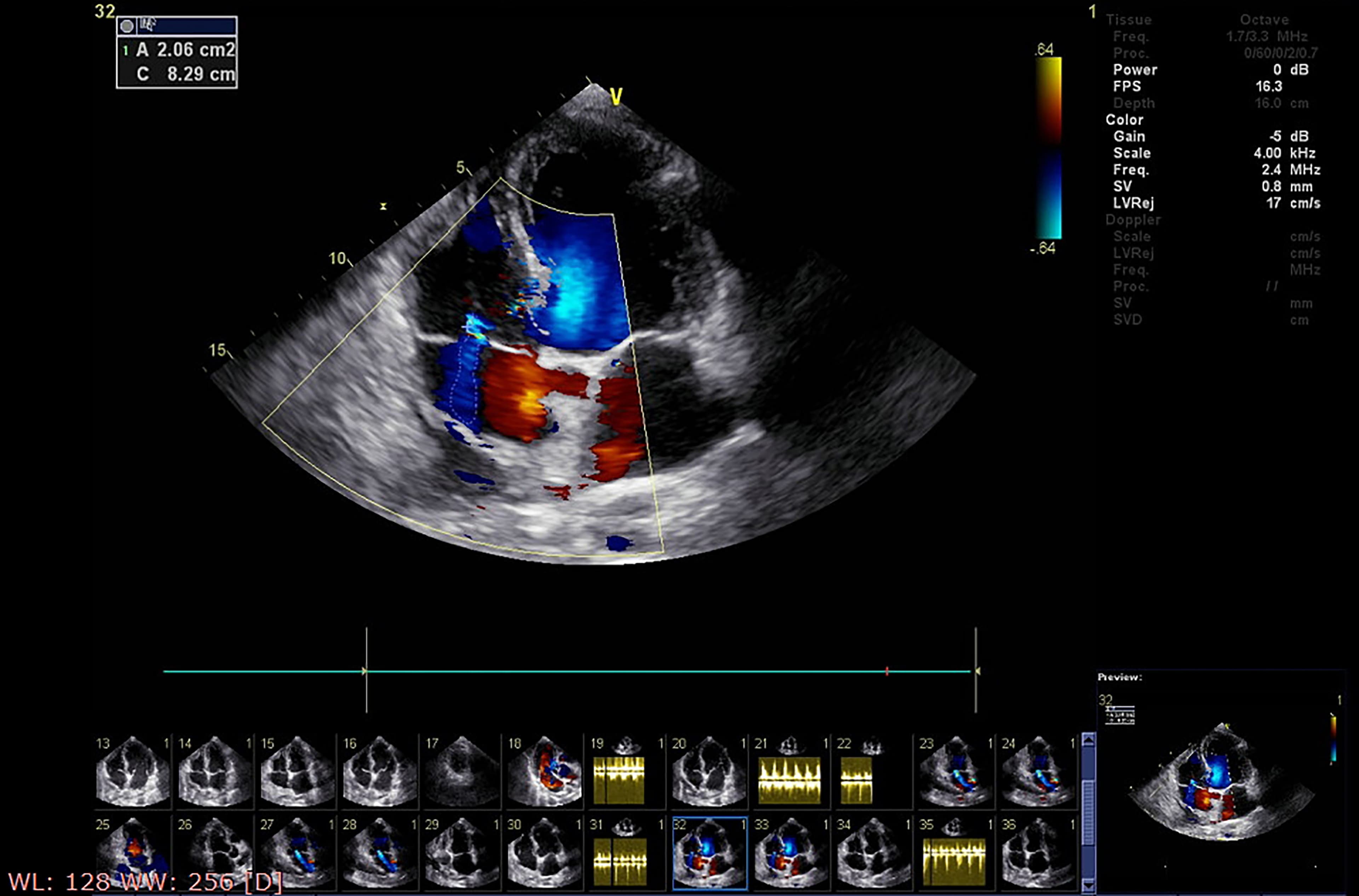 Echocardiography machine screen